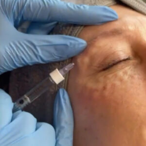 microneedling-sq